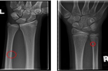 Local-Entropy Based Approach for X-Ray Image Segmentation and Fracture Detection