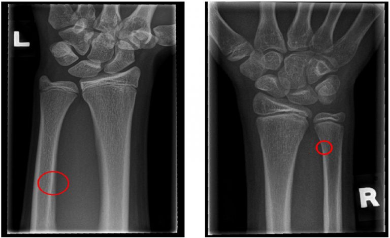 Local-Entropy Based Approach for X-Ray Image Segmentation and Fracture Detection